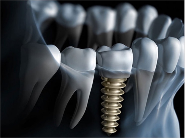 Oralna implantologija